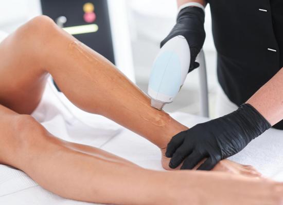 L'épilation au laser diode : une technologie de pointe pour des résultats durables