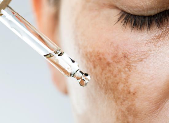 De oorzaken van donkere vlekken: hoe ze te vermijden en te behandelen