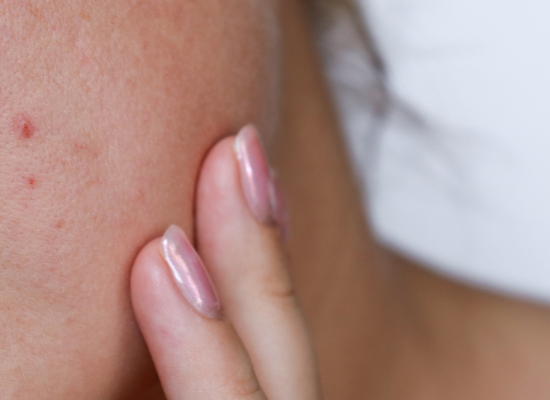 Acné bij tieners: de fouten om te vermijden en de routine om toe te passen